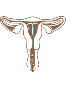 Contraceptives - IUD